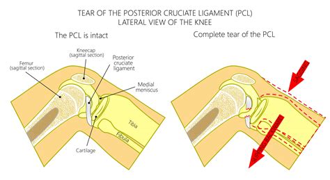 what is a pcl rupture